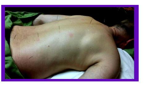 acupuncture back